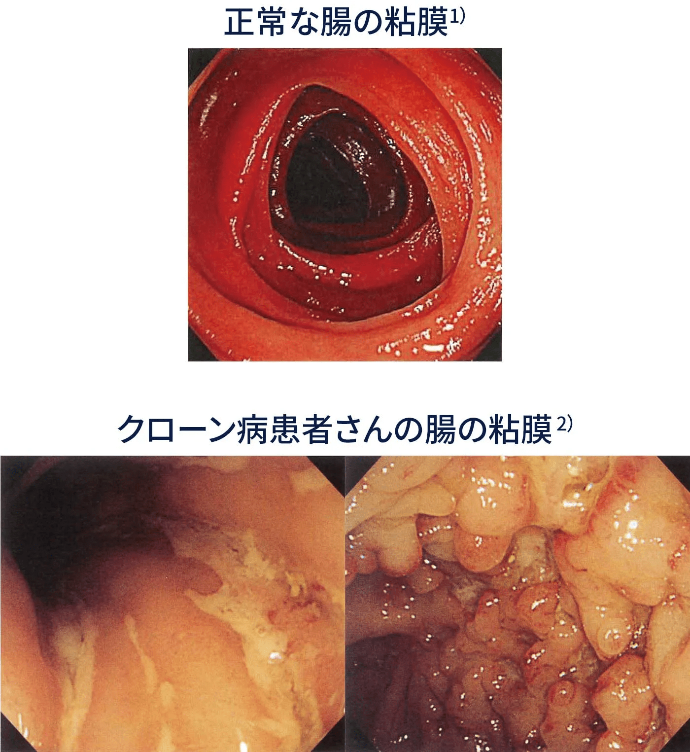 写真：正常な腸の粘膜1) クローン病患者さんの腸の粘膜2）
