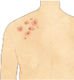 乾癬 皮膚の症状イメージ
