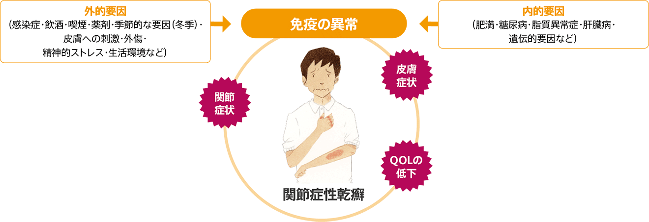関節症性乾癬の原因 外的要因(感染症・飲酒・喫煙・薬剤・季節的な要因(冬季)・皮膚への刺激・精神的ストレス・生活環境など) 内的要因(肥満・糖尿病・脂質異常症・肝臓病・遺伝的要因など) 免疫の異常 皮膚症状 QOLの低下