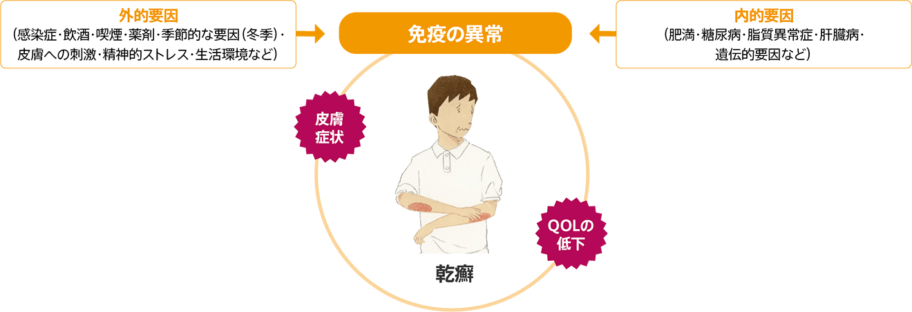 乾癬の原因 外的要因(感染症・飲酒・喫煙・薬剤・季節的な要因(冬季)・皮膚への刺激・精神的ストレス・生活環境など) 内的要因(肥満・糖尿病・脂質異常症・肝臓病・遺伝的要因など) 免疫の異常 皮膚症状 QOLの低下