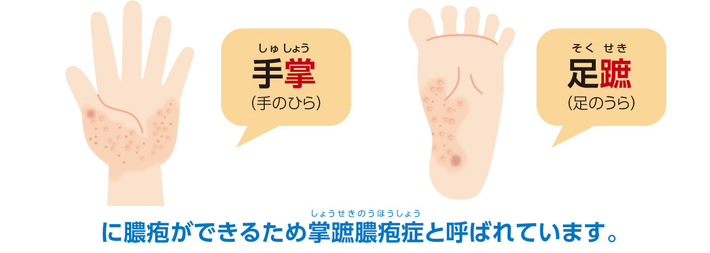手掌（しゅしょう。手のひら）・足蹠（そくせき。足のうら）に膿疱ができるため掌蹠膿疱症（しょうせきのうほうしょう）と呼ばれています。