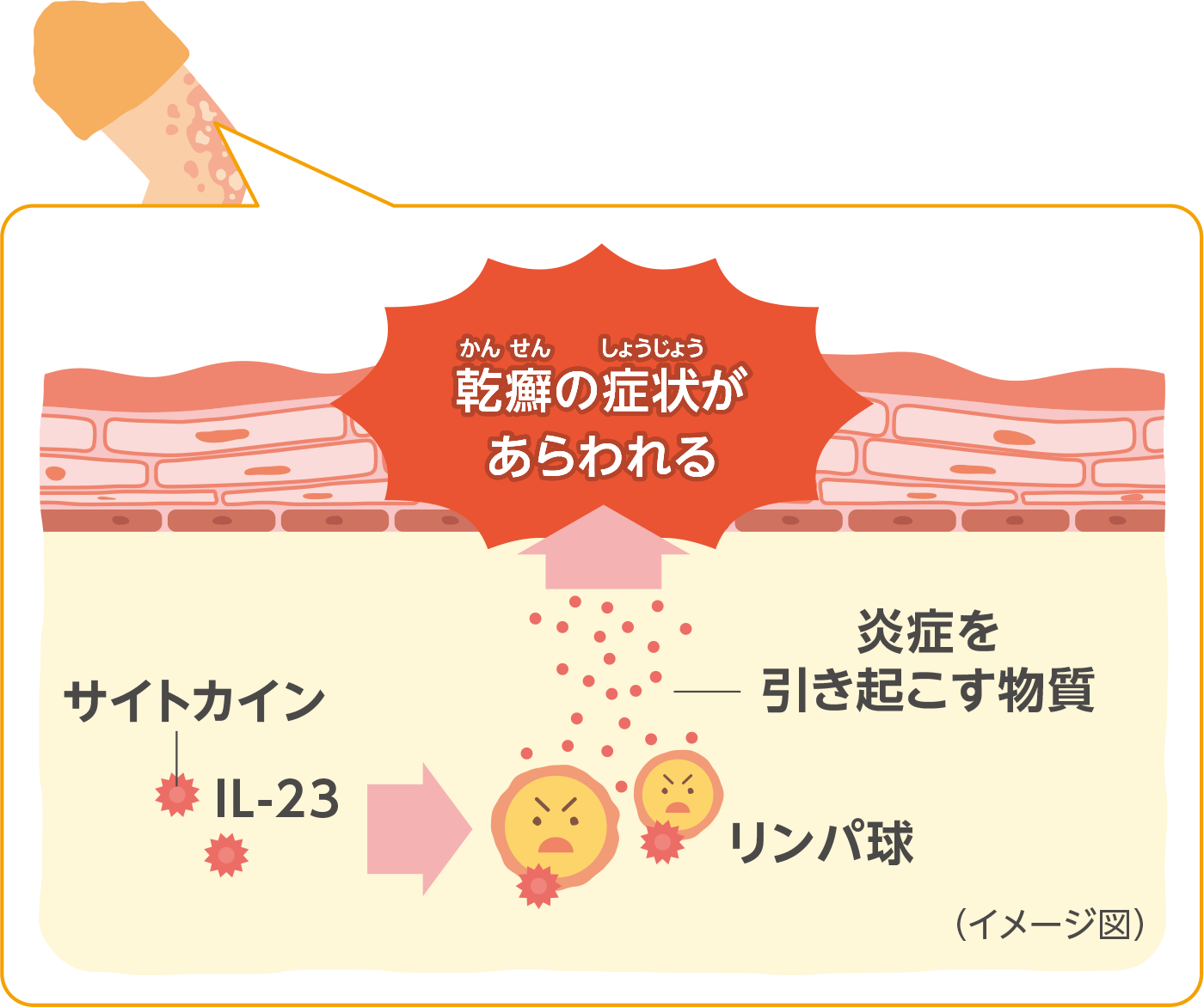 乾癬の発症