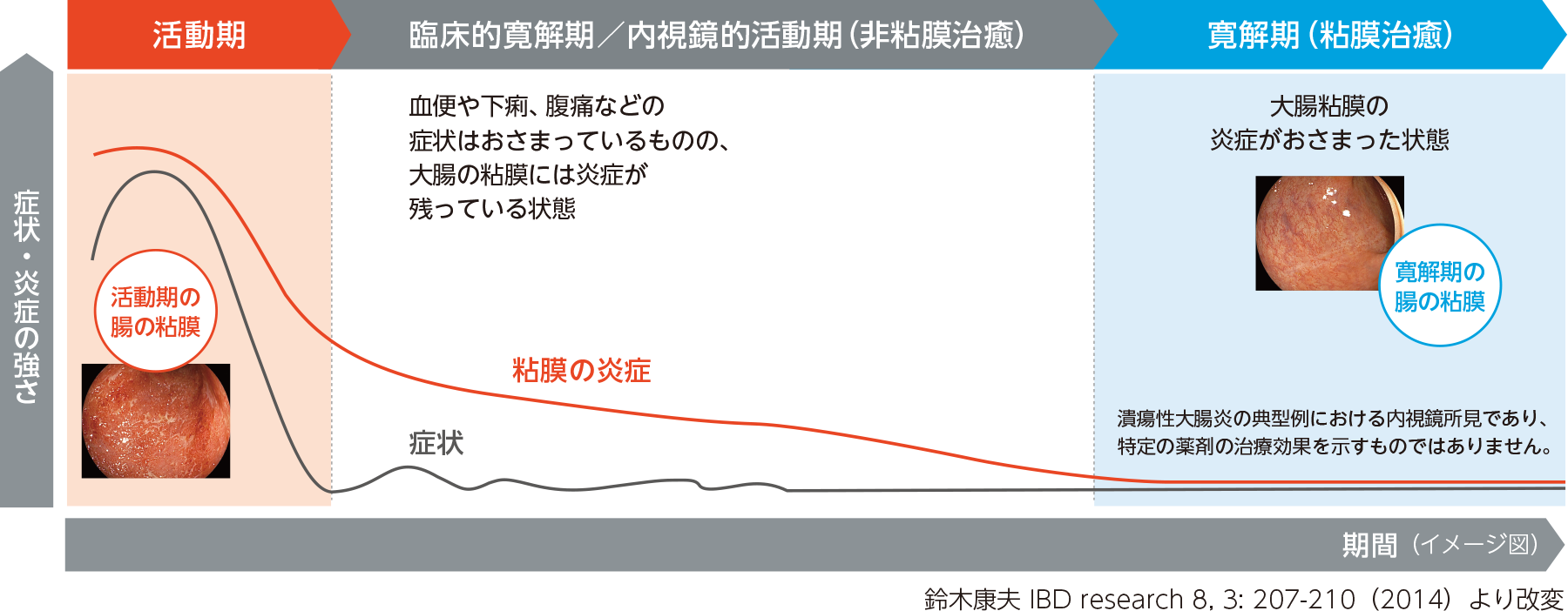 症状の経過と粘膜の炎症（イメージ図）。出典：鈴木康夫 IBD research 8,3: 207-210（2014）より改変